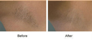 best professional laser underarm hair removal 