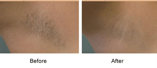 underarm hair removal before & after photo