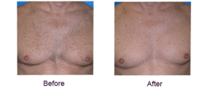 best professional laser chest hair removal 