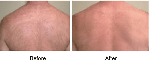 back hair removal
