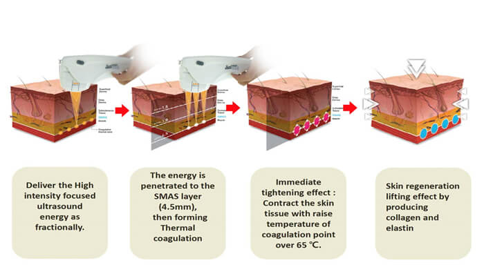 Skin tightening with the current popular Hifu technology