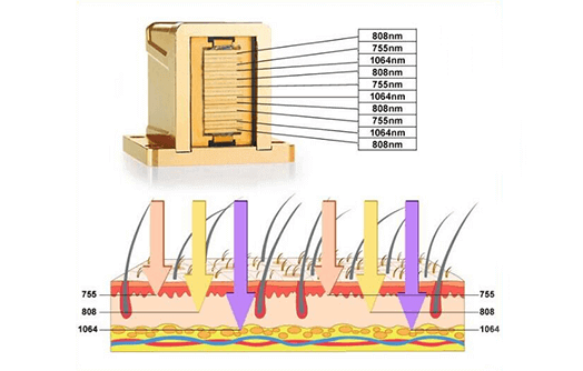 Diode Laser Hair Removal - 3 different wavelengths