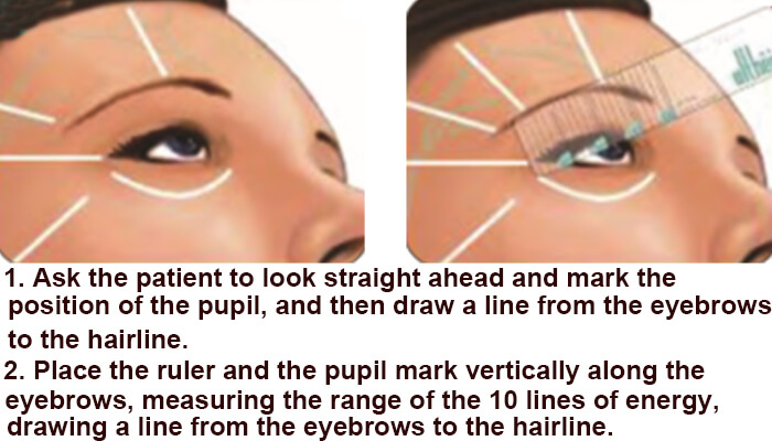 Eyebrow area