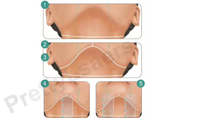 Marking Line Planning: Upper Head (Mandibular Area)