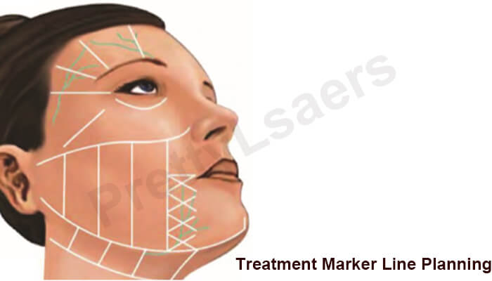 Treatment Marker Line Planning