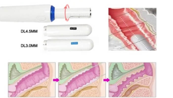 HIFU Vaginal Tightening