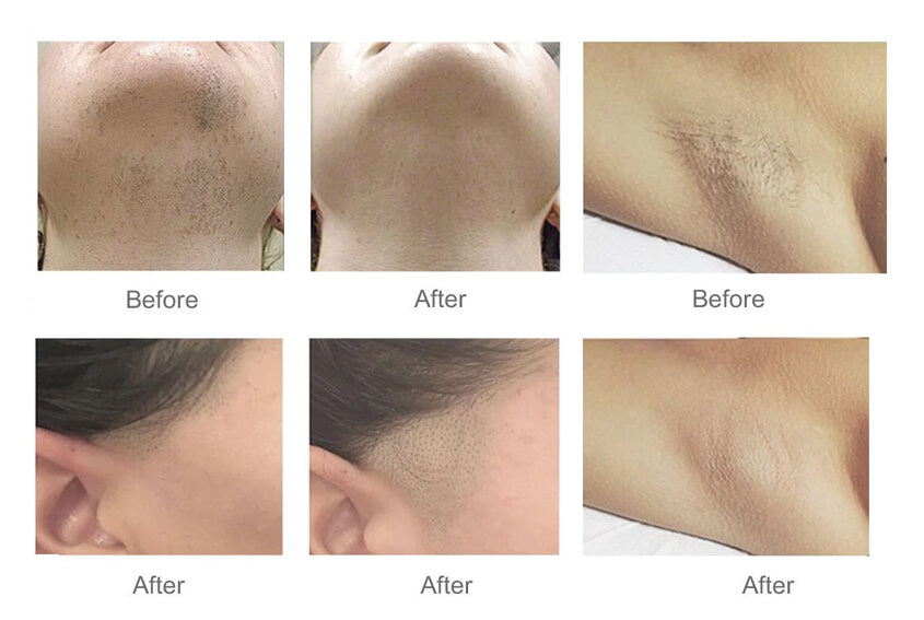 Diode Laser Hair Removal Results