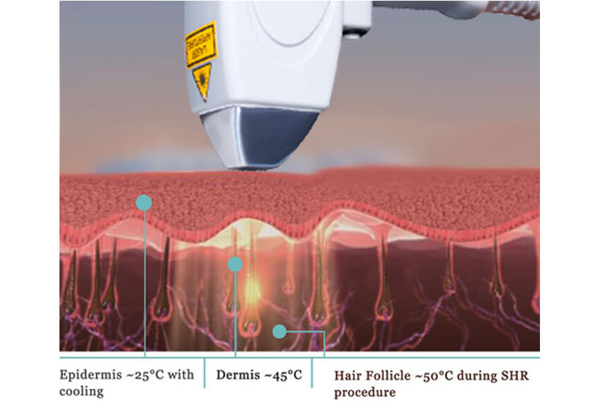 Diode Laser Hair Removal Treatment Principle