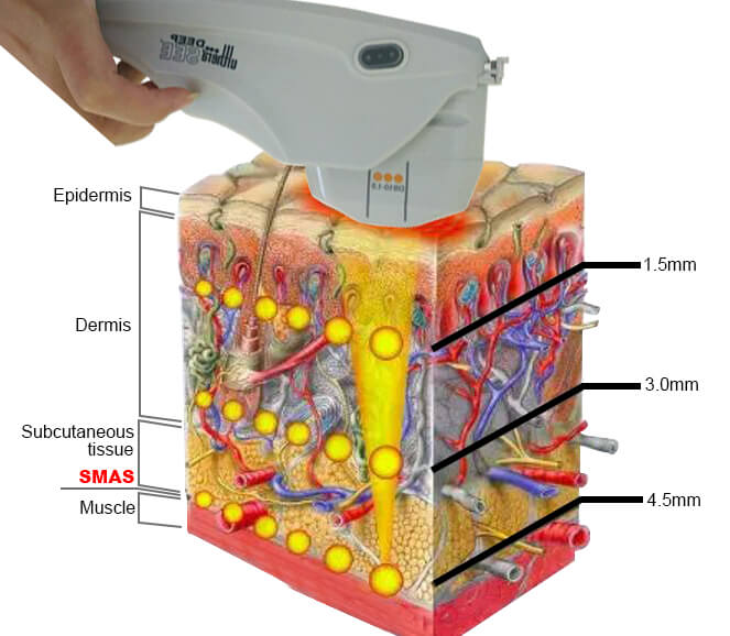 HIFU Ultherapy Theory