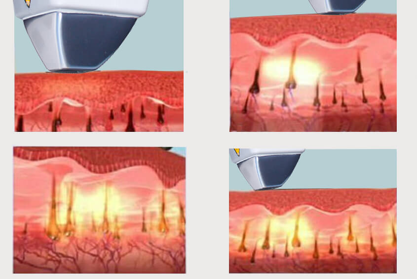 Diode Laser Hair Removal Theory