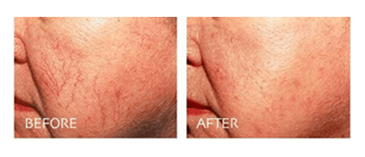 980nm Diode Laser Treatment Before & After Pictures