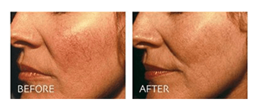 980nm Diode Laser Treatment Before & After Pictures