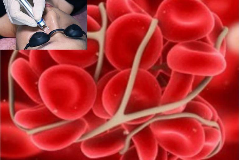 [Spider Veins & Vascular] 980nm Laser Removal Machine | PrettyLasers