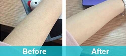Arm Hair Removal For Woman