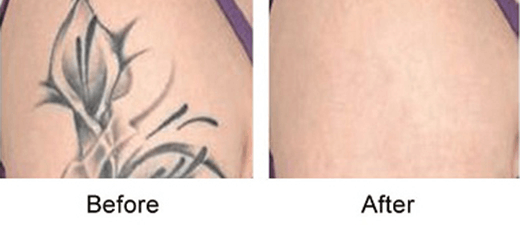 Arm Tattoo Removal