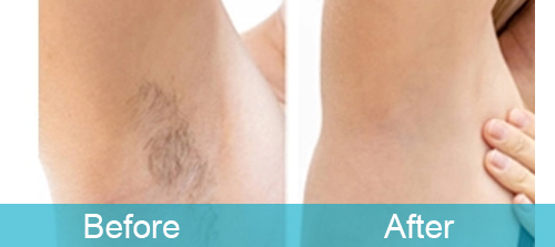 Armpit Hair Reduction For Female