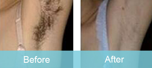 Armpit Hair Reduction For Women