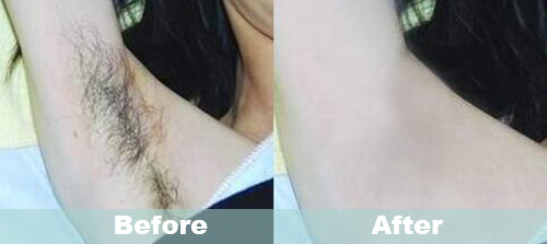 Armpit Hair Removal