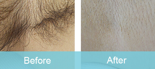 Armpit Hair Removal For Male