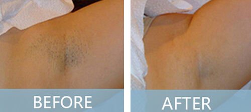 Armpit hair removal