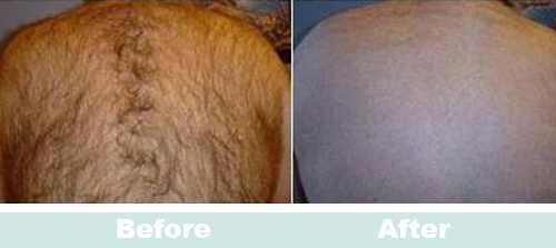Back Hair Reduction