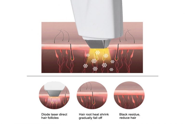 Permanent Diode Laser Hair Removal System For All Skin PrettyLasers