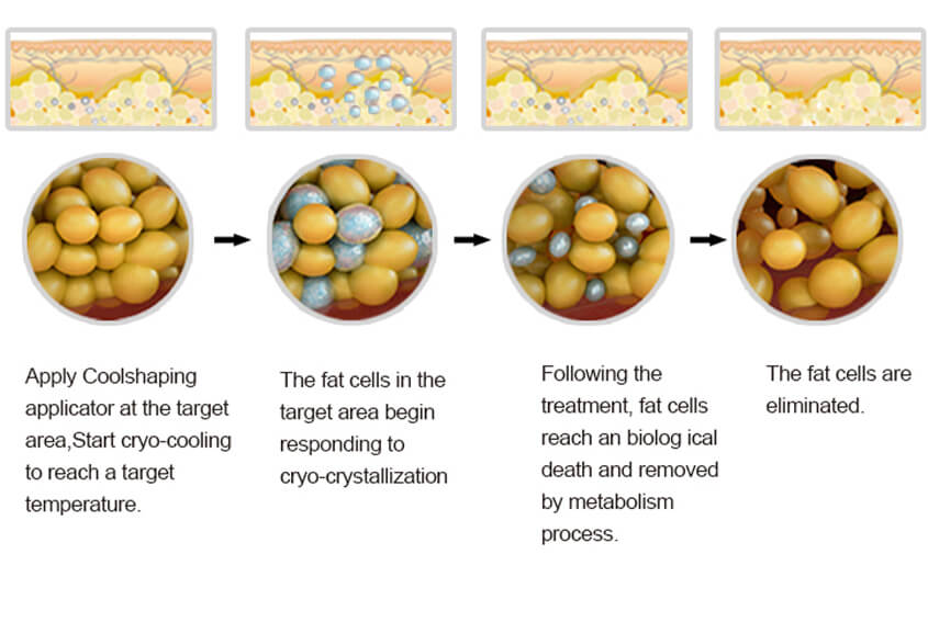 Cellulite Removal Treatment Principle