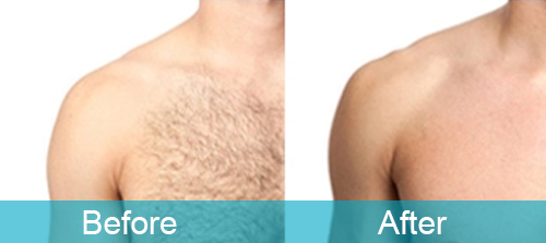 Chest Hair Removal 