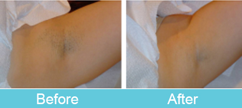 Diode Laser Epilation Treatment