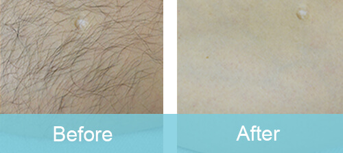 Leg Hair Removal For Man