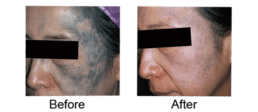 Face Tattoo Rremoval Before And After