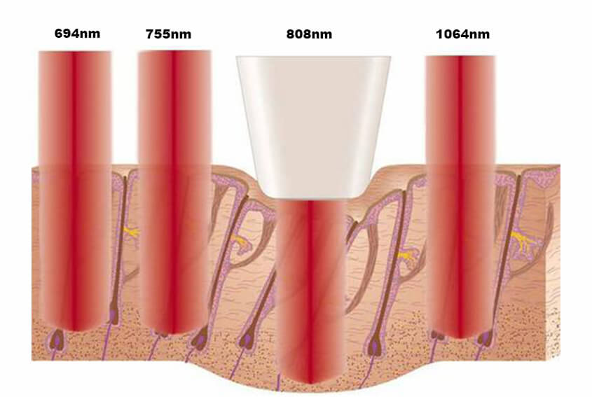 Golden Standard 808nm Diode Laser Hair Removal