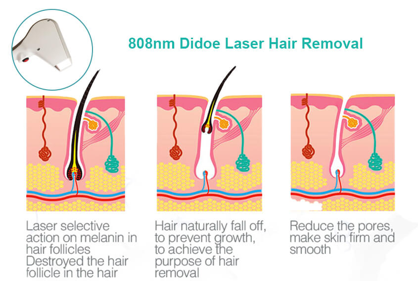 How Does A Portable Laser Hair Removal Machine Work?