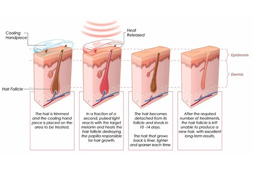 How Doese A Diode Laser Hair Removal Systme Work?