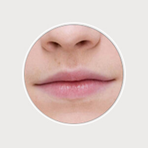 Lip Hair Removal