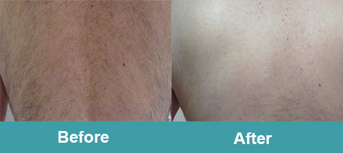Male Back Hair Reduction