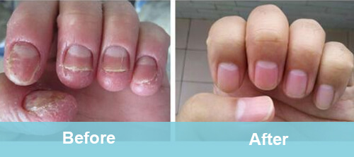 Nails Fungus Removal Treatment