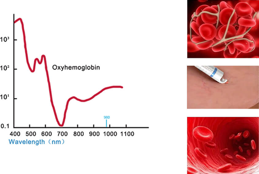 980nm Diode Laser Treatment Theory