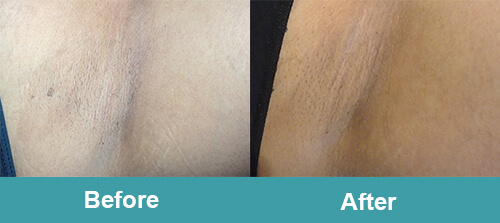 Underarm Laser Hair Removal