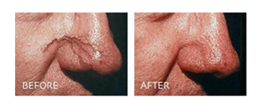 Spider Veins Removal On Nose