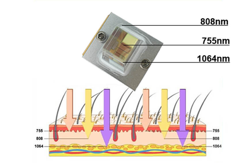 Diode Laser Hair Removal - 3 different wavelengths