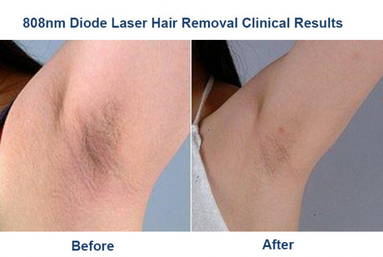 Diode Laser Semiconductor Technology for Hair Reduction PrettyLasers