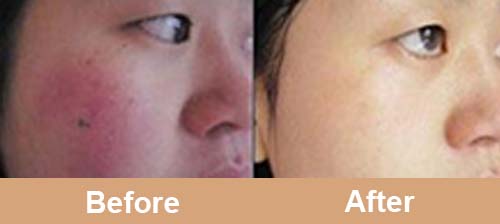 980nm_diode_laser_treatment_before_after_photos