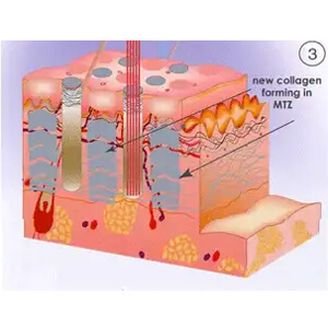 A second treatment creates more Microthermal Treatment Zones as the collagen from the first treatment remodels and tightens.