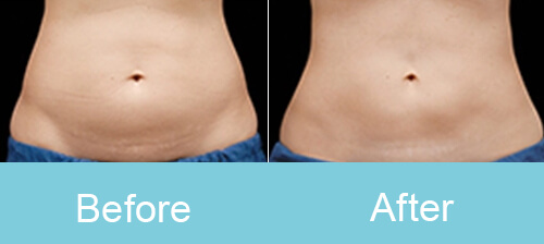 Cryolipolysis Grouponcryotherapy Slimming Machinecryolipolysis