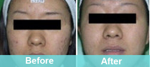 Acne Removal