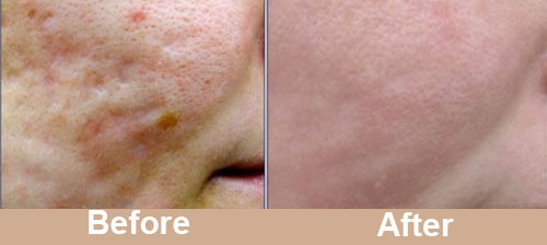 Acne_Scar_Laser_Treatment