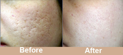 Acne_Scar_Laser_Treatment_before_after_photos