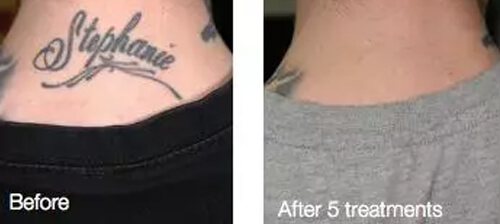 After Five Laser Tattoo Removal Treatment