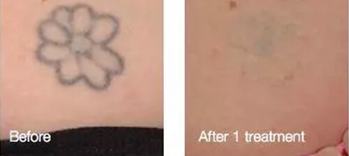 After One Laser Tattoo Removal Treatment